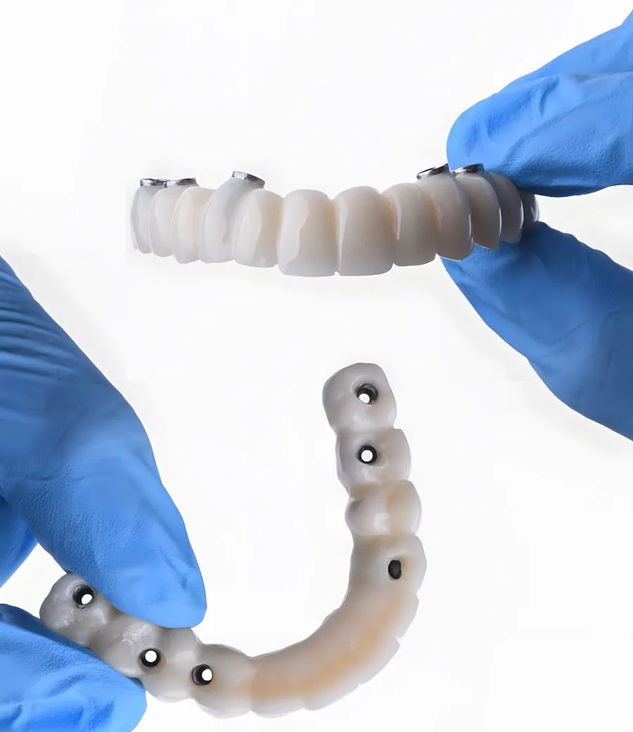 All-on-6 Full Arch — treatment illustration