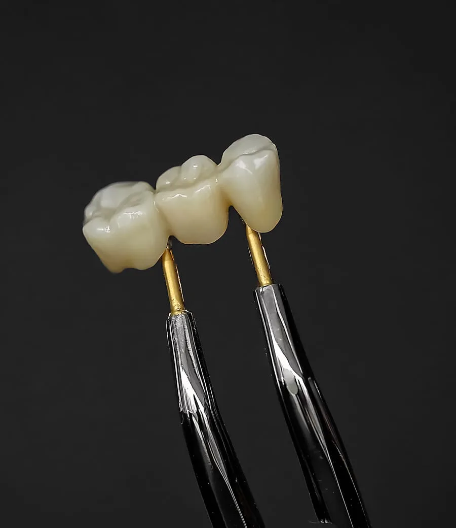 Crowns & Bridges — treatment illustration