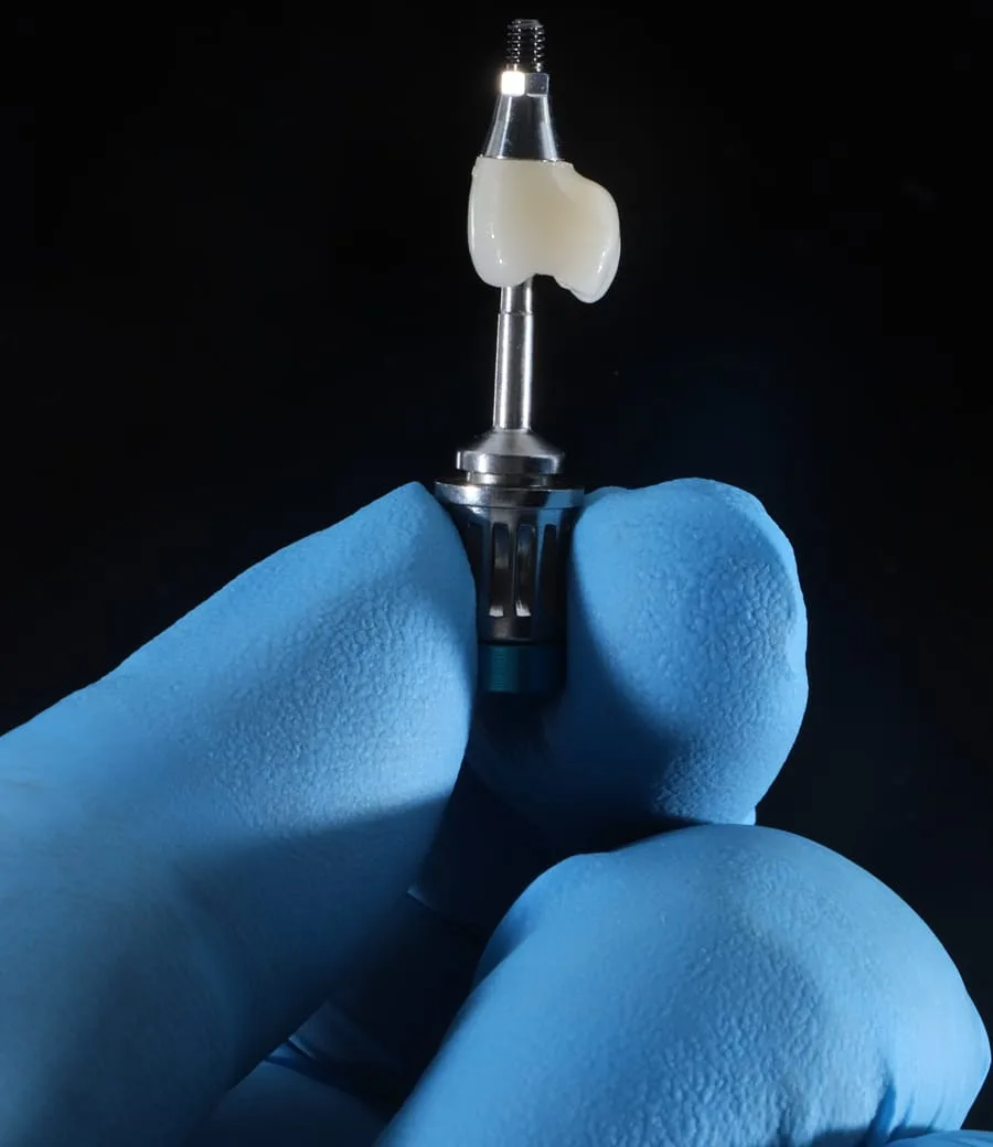 Single Dental Implant — treatment illustration