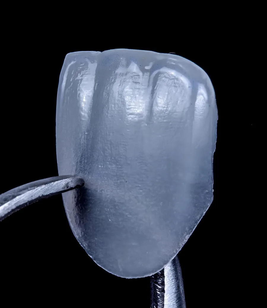 Porcelain Veneers — treatment illustration